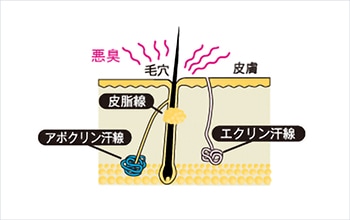 ワキガ