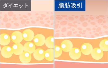 脂肪吸引とは?