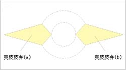 真皮皮弁の周りを、緑の線にそって真皮部分まで切開していきます。