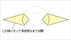 乳頭形成を行う部分を持ち上げ、左右の各真皮皮弁を皮下トンネルを通して交差させます。そして対側の真皮組織と皮下縫合します。