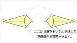 乳頭形成を行う部分を持ち上げ、左右の各真皮皮弁を皮下トンネルを通して交差させます。そして対側の真皮組織と皮下縫合します。