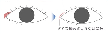 W-plasty法
