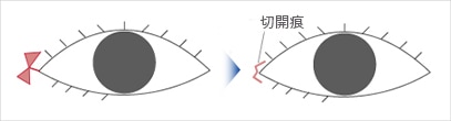 W法(ひだを開く)