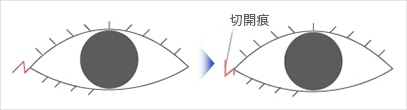 W法(ひだを開く)