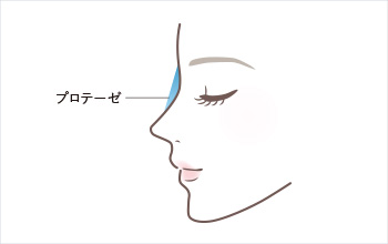 隆鼻術