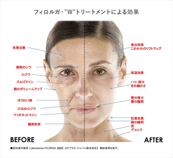 フィロルガ・”W”トリートメントによる効果