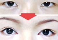 麻酔を確認し眼の上を切開