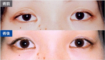 眼瞼下垂＋小切開＋脱脂