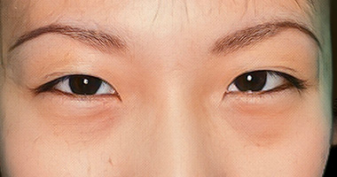 クマ治療 施術前