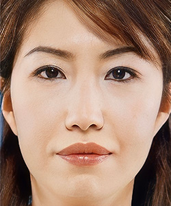 ハムラ法 施術後