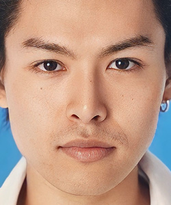 目頭切開 施術後