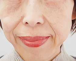 下眼瞼切開 施術後