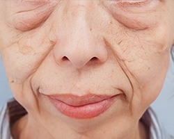 下眼瞼切開 施術前