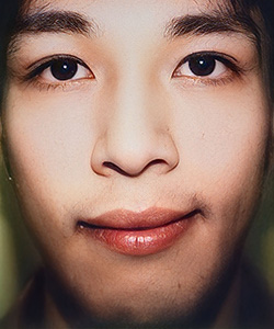 マイクロカット法 施術後