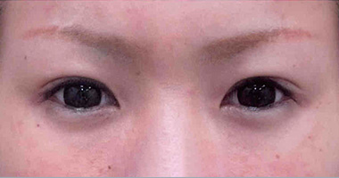 マイクロカット法 施術後