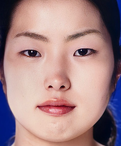 ミニマムカット法 施術前