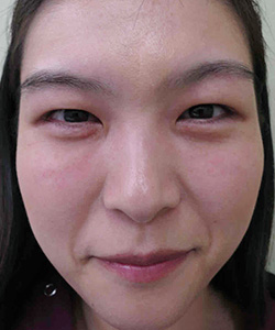 マイクロカット法 施術前