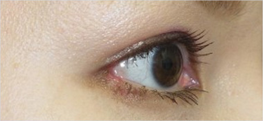 目尻切開 施術後