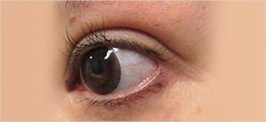 目頭切開 施術前