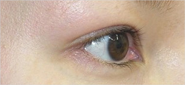 目頭切開 施術前
