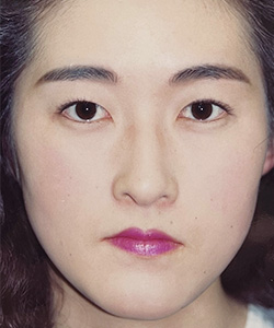 パラレルクイック埋没法 施術後