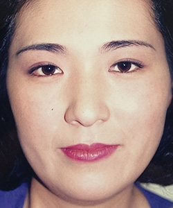 パラレルクイック埋没法 施術後