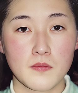 パラレルクイック埋没法 施術前