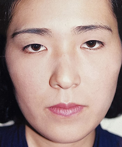 パラレルクイック埋没法 施術前