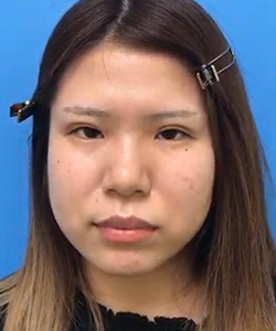 眼瞼下垂 施術後