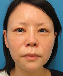 眼瞼下垂 施術後