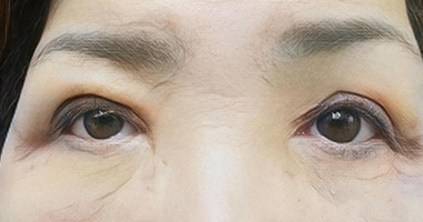 上眼瞼脂肪注入 施術後