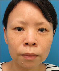 眼瞼下垂 施術前