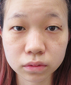 涙袋形成術（ヒアルロン酸注入/脂肪注入） 施術前