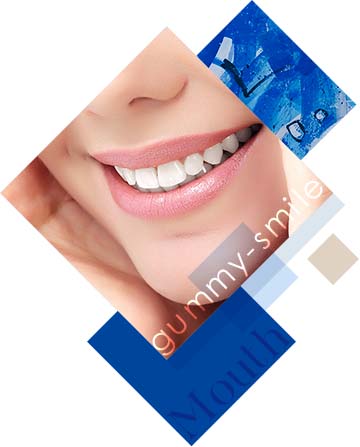 ガミースマイル(ボトックス注入・耳介軟骨移植)