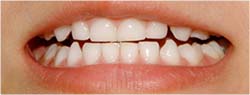 歯が小さく、歯茎が目立ってしまう。