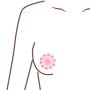 乳輪縮小術