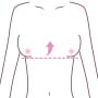 乳房挙上(マストペクシー)