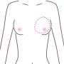 乳房再建